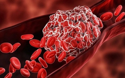 Cảnh báo các dấu hiệu nhận biết cục máu đông