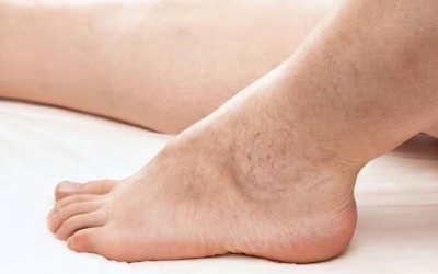 3 dấu hiệu trên da cảnh báo bệnh tim mạch