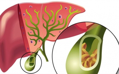 Sỏi mật không triệu chứng, không đau có phải mổ không?