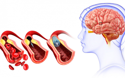 Hẹp động mạch cảnh - hiểm họa âm thầm gây tai biến mạch máu não