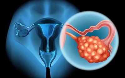 Hiểu về u nang buồng trứng