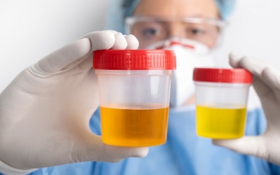 Mùi nước tiểu có thể là dấu hiệu cảnh báo bệnh suy thận