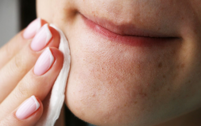 Cách loại bỏ và ngăn ngừa mụn đầu đen hiệu quả