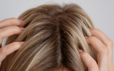 Cách nhận biết các loại gàu trên da đầu