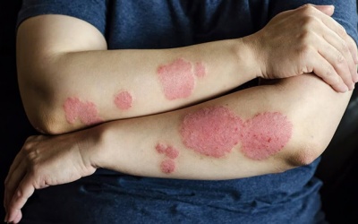 4 mẹo giúp làm sạch vảy nến trên da 