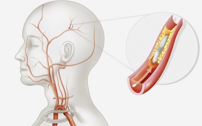 Cảnh giác biến chứng đột quỵ do mỡ máu cao