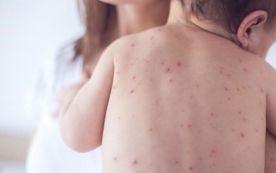 Chăm sóc đúng cách khi trẻ mắc thủy đậu để tránh bị sẹo 