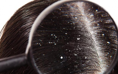Gội đầu thường xuyên sao vẫn bị gàu?