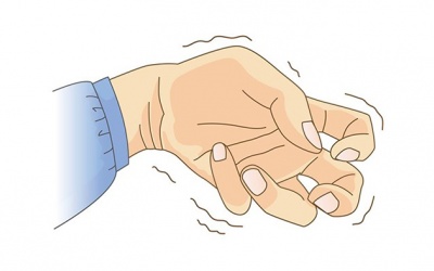 Run tay trái khi cầm đồ vật là bị bệnh gì?