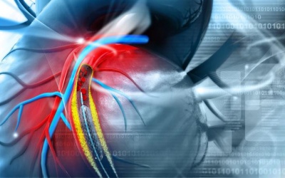 Phải làm sao khi bắc cầu mạch vành bị hỏng?