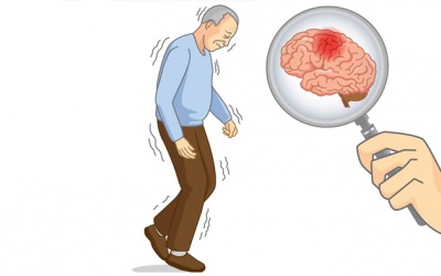 Hội chứng Parkinson do rối loạn ngoại tháp là tình trạng gì?