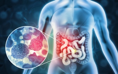 Australia: Đột phá trong nghiên cứu phát hiện sớm ung thư ruột