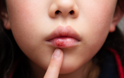 Nguyên nhân gây ra tình trạng môi khô, nứt nẻ và cách khắc phục?