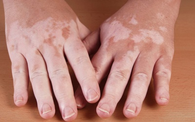 Bệnh bạch biến có nguy hiểm không và giải pháp từ thảo dược