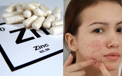 Lợi ích của kẽm với làn da mụn