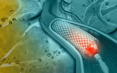 Bệnh mạch vành: Đặt stent có bền không, có phải thay stent không?