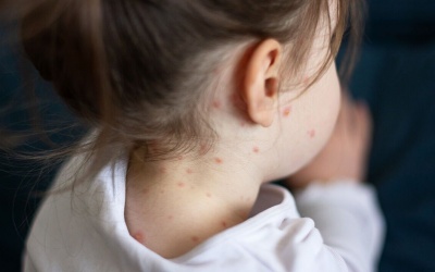 WHO: Hơn một nửa thế giới đối mặt với nguy cơ bùng phát dịch sởi