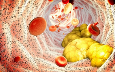 Những điều cần biết về tình trạng máu nhiễm mỡ