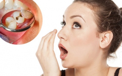 Mách bạn cách trị hôi miệng do sâu răng 