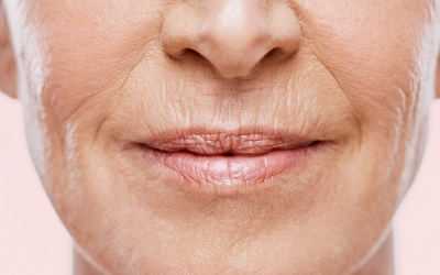 Nguyên nhân chính khiến môi nhiều nếp nhăn