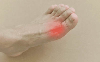 Sinh hoạt, ăn uống thế nào khi bị gout ngón chân cái?