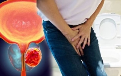 Dấu hiệu ung thư tuyến tiền liệt bạn không nên bỏ qua