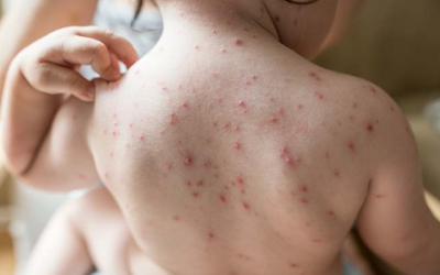 Điều trị thuỷ đậu cần tránh mắc 5 sai lầm này