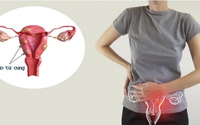 U xơ tử cung có nguy hiểm không? 