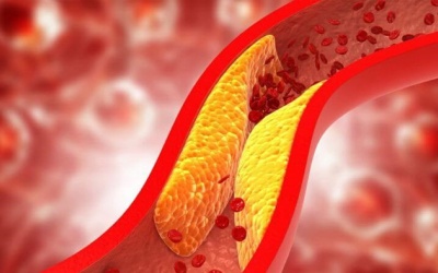 Bị thiếu máu cơ tim có thể dùng TPBVSK Ích Tâm Khang Platinum thế nào?