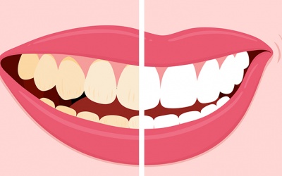 Các loại thực phẩm, đồ uống nào dễ khiến răng ố vàng?