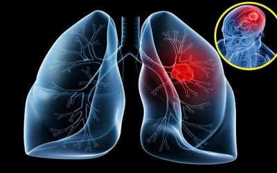 Vẫn sống khỏe sau 7 năm mắc ung thư phổi di căn não