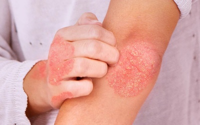 Người bệnh chàm eczema nên bổ sung dưỡng chất nào?