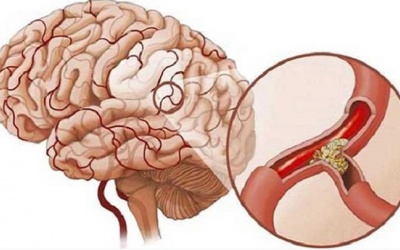 Làm thế nào để giảm nguy cơ nhồi máu não?