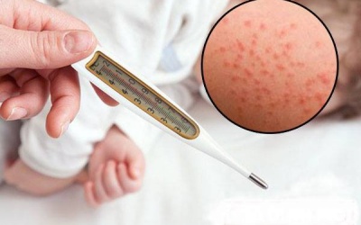 Bộ Y tế chỉ đạo tăng cường công tác phòng chống bệnh sởi 