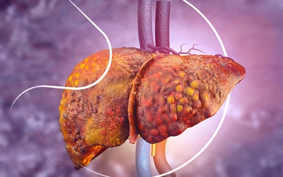 FDA phê duyệt loại thuốc đầu tiên điều trị bệnh gan nhiễm mỡ