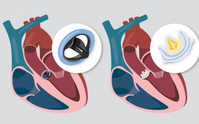 Hở van tim: Thay van tim chi phí thế nào? 