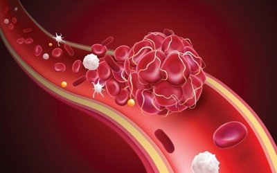 3 biện pháp hỗ trợ phòng ngừa cục máu đông  