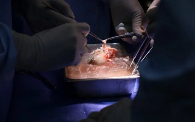 Bệnh nhân được ghép thận lợn biến đổi gene đã xuất viện