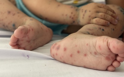 Số ca mắc bệnh tay chân miệng tăng cao ở Hà Nội