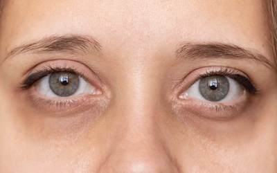 Có những cách nào giúp loại bỏ quầng thâm dưới mắt?