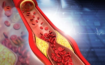 Máu nhiễm mỡ gây tác hại gì cho sức khỏe?