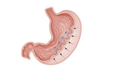 Phẫu thuật thu nhỏ dạ dày ESG có giúp giảm cân?