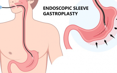Phẫu thuật nội soi thu nhỏ dạ dày giảm cân có an toàn không?