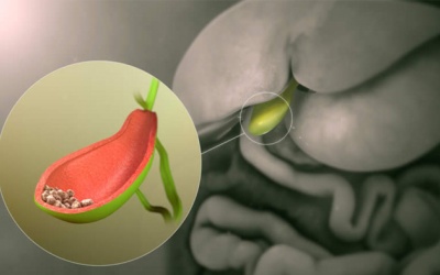 Sỏi túi mật 10mm có nguy hiểm không?