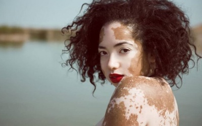 Liệu bạch biến có thể tự khỏi được không?