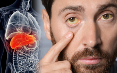 7 dấu hiệu trên da cảnh báo bệnh gan nhiễm mỡ