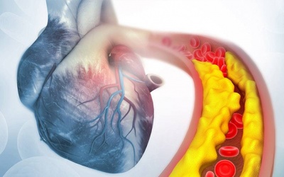 Thiếu máu cơ tim kèm bệnh mạch vành, cần làm gì để giảm nguy cơ đặt stent?
