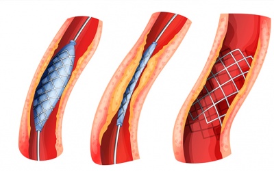 Stent thường, stent phủ thuốc, stent tự tiêu loại nào tốt hơn?