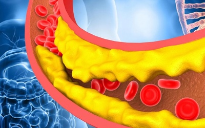 5 đối tượng dễ mắc máu nhiễm mỡ
