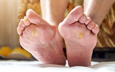 Đái tháo đường: 5 lời khuyên giúp phòng ngừa biến chứng loét bàn chân